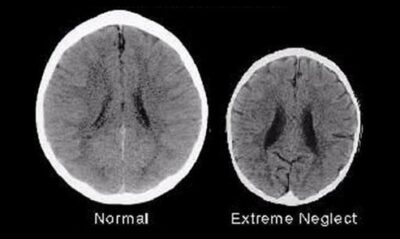Razvoj mozga direktno je povezan s ljubavlju ili zanemarivanjem od strane roditelja